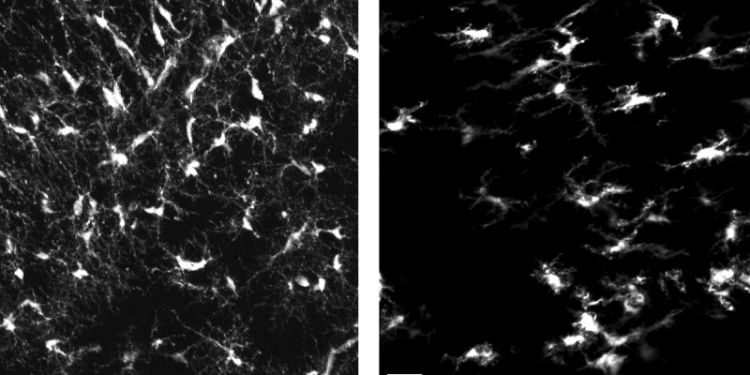 Mutated brain defenders likely factor of early-onset Parkinson’s disease