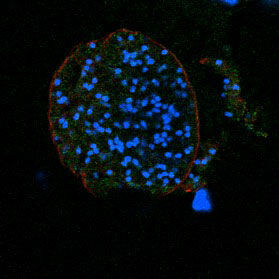 Disease DA Brain Cyst