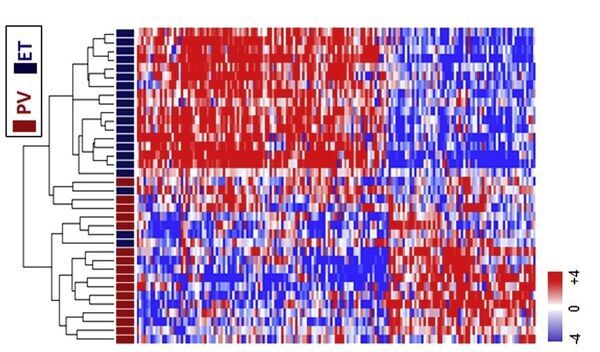 Differential gene expression in haematological malignancies Polycytemia Vera (PV) and Essential Thrombocytemia (ET)