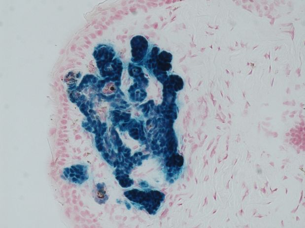 Activation of Hedgehog signalling (blue) in a spontaneous basal cell carcinoma in Dsg2 transgenic mouse with Ptc1 haploinsufficiency (K14-Dsg2; Ptc1+/lacZ)(courtesy of Dr. Natalia Riobo-Del Galdo)