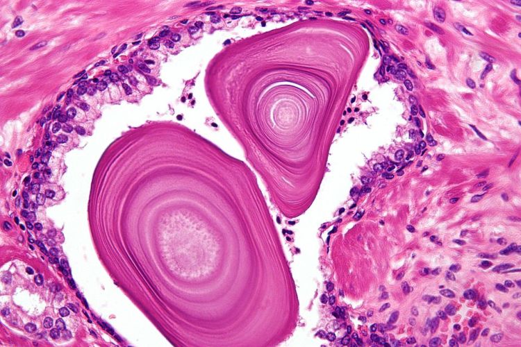 Leeds scientist wins £125k funding to develop new protein-level strategies for fighting lung cancer. 